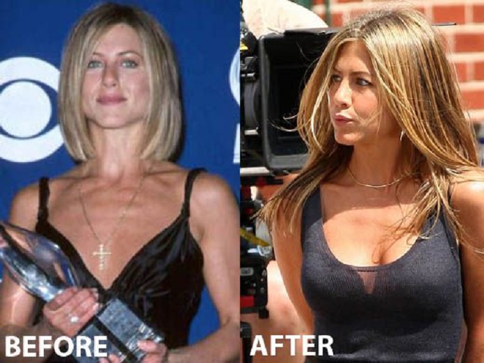 Jennifer Aniston Plastic Surgery