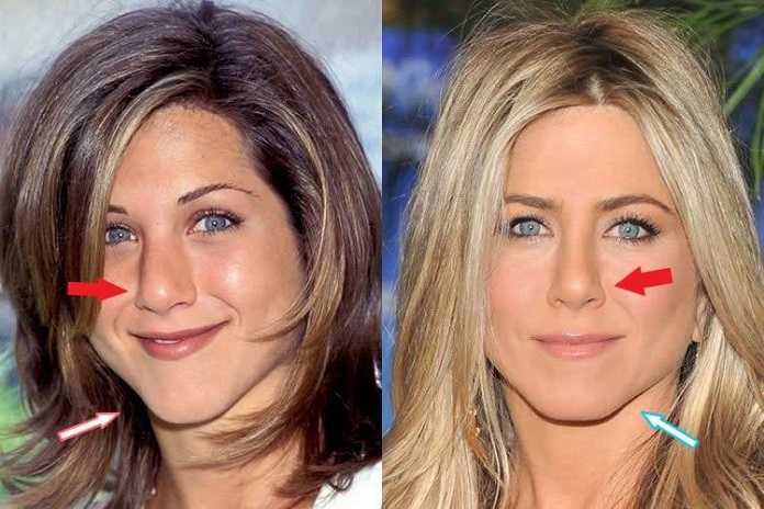 Jennifer Aniston Plastic Surgery