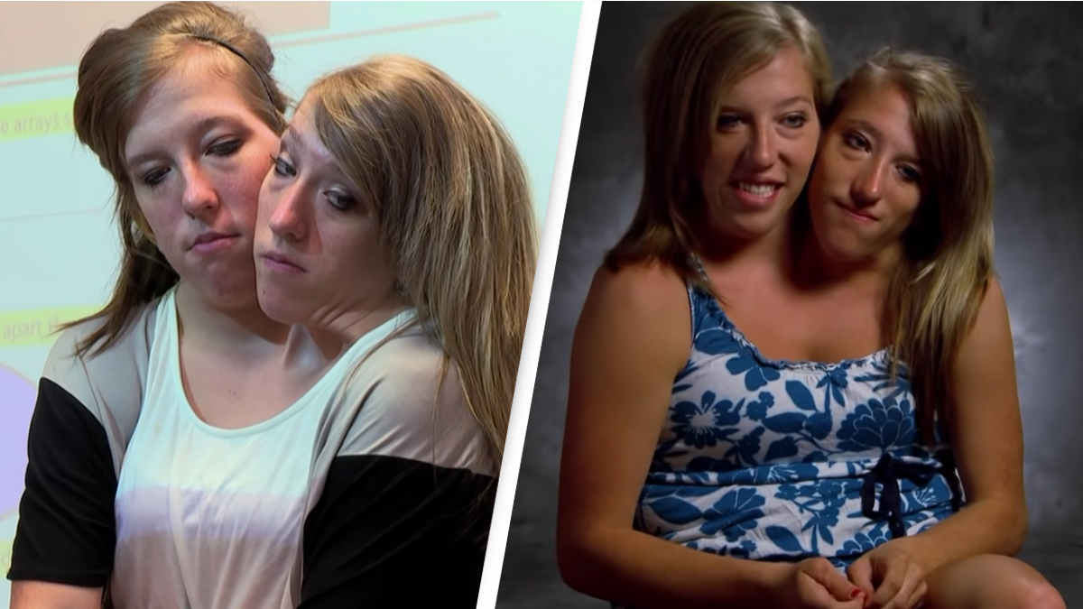 Conjoined twins Abby and Brittany Hensel dream of getting married